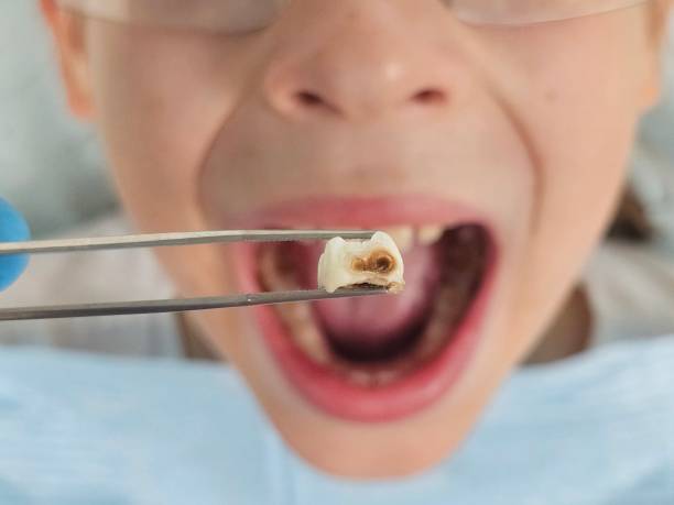 Best Cracked Tooth Emergency Dentist  in Carrollton, VA